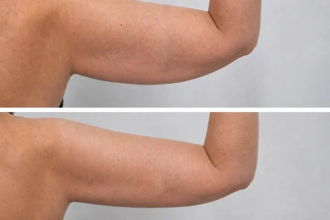 brazos-antes-despues